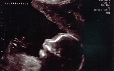 What Happens During an Ultrasound?