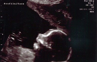 Ultrasound image of a baby's face/profile